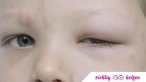 Mückenstich bei Baby