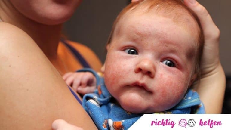 Neurodermitis bei Kindern - Richtig helfen