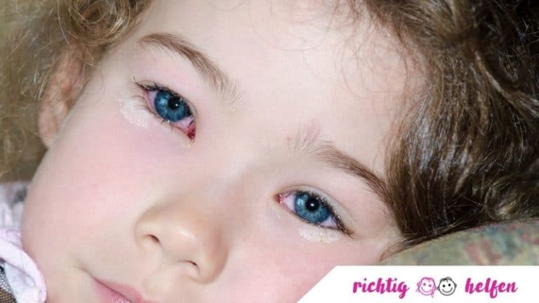 Bindehautentzündung bei Kindern - Richtig helfen