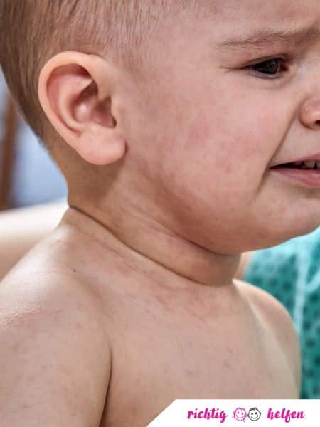 Baby mit Ausschlag